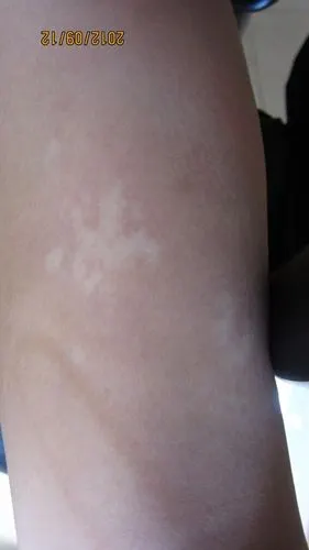 婴儿汗斑图片 (22)_有来医生