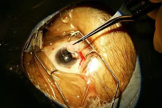 验光,概念,漂亮,美女,眼睛,检查,眼科医生眼镜放在视力表背景上眼镜