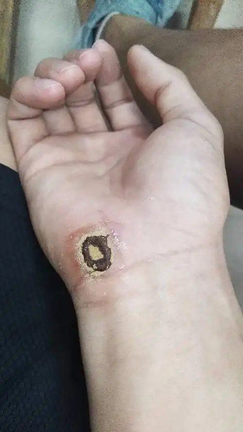 昨天开车摔了一跤,擦破皮了