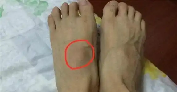 痛风一般在什么部位 脚背痛是不是痛风?