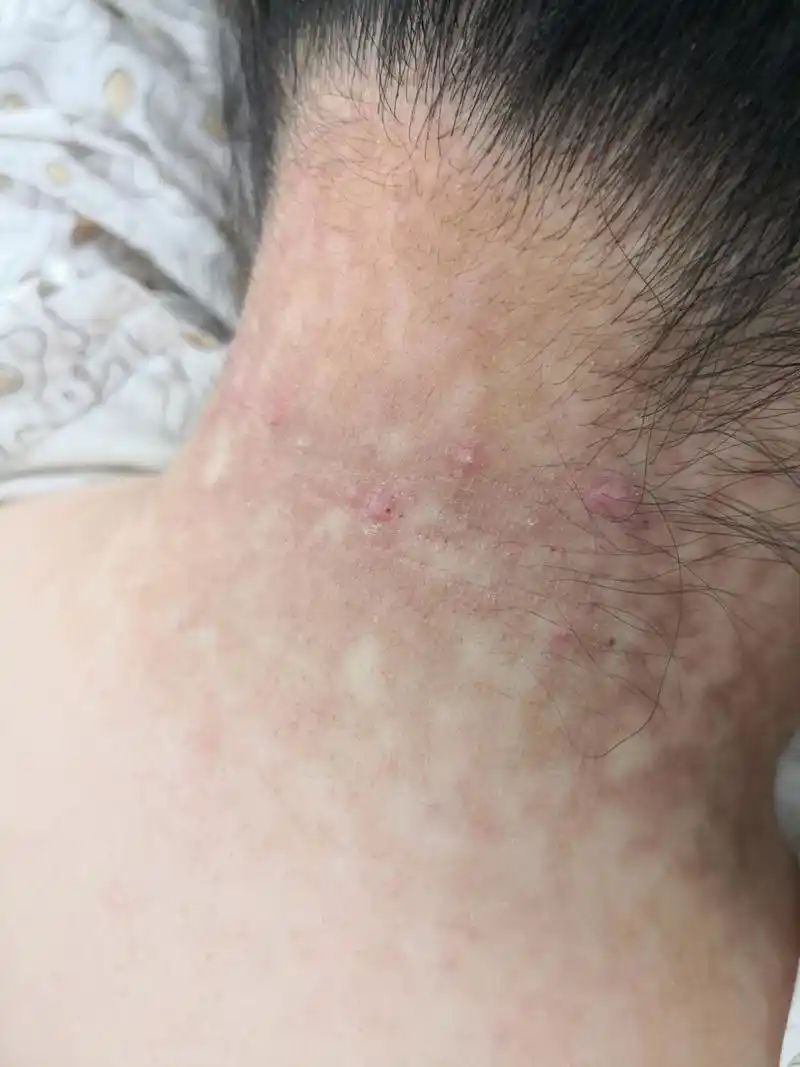 颈周腋下乳房下的黄褐色斑片#解决皮肤问题专注皮肤美容##花斑癣