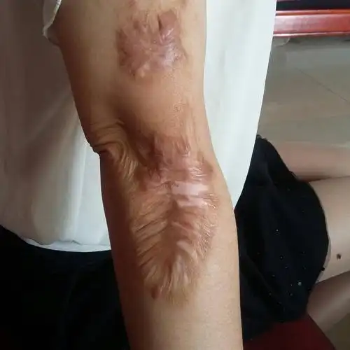 我五年不小心被火烧伤了手,留下了好大一块疤,一直