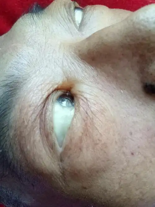 谁知道白眼球这样是什么问题