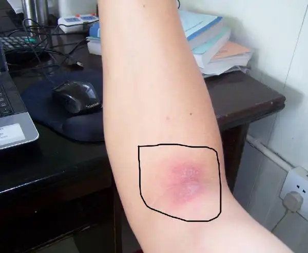 皮肤病吗?手肘内侧,有点痛.