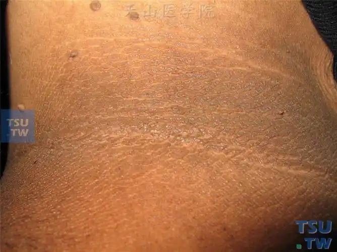 【附图】 黑棘皮病(acanthosis nigricans)症状表现 _皮肤病诊断图谱