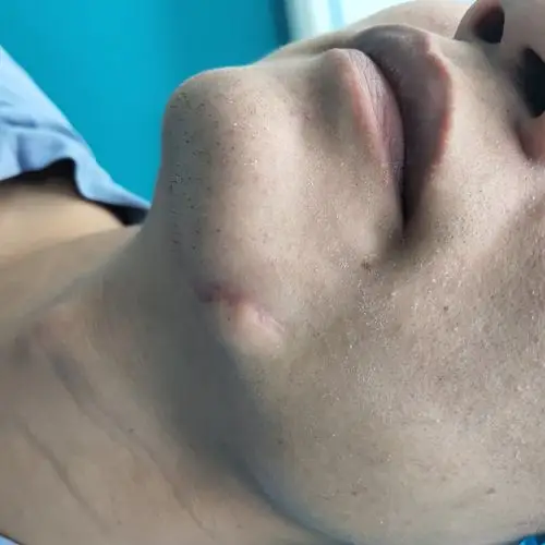 疤痕案例十四:下巴刀伤缝合后疤痕增生案例解析 - 好大夫在线
