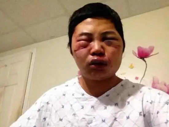 美华裔男子送外卖时被打至鼻青脸肿短暂失忆