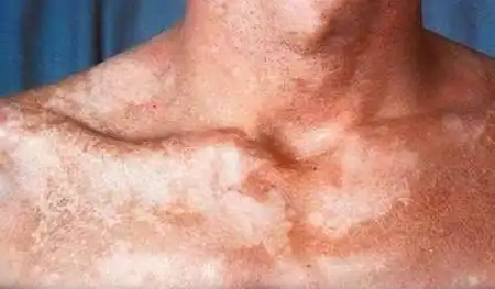 谁得过汗斑这种病的,放点什么药膏能解决啊,知道的帮帮我!