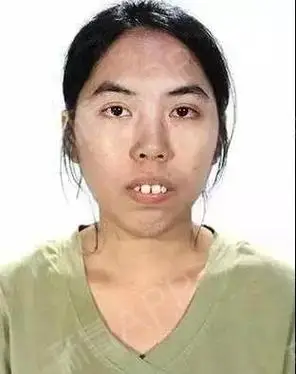 23岁泰国龅牙丑mm,整容后变万人迷,工作爱情双丰_圈子-新氧美容整形