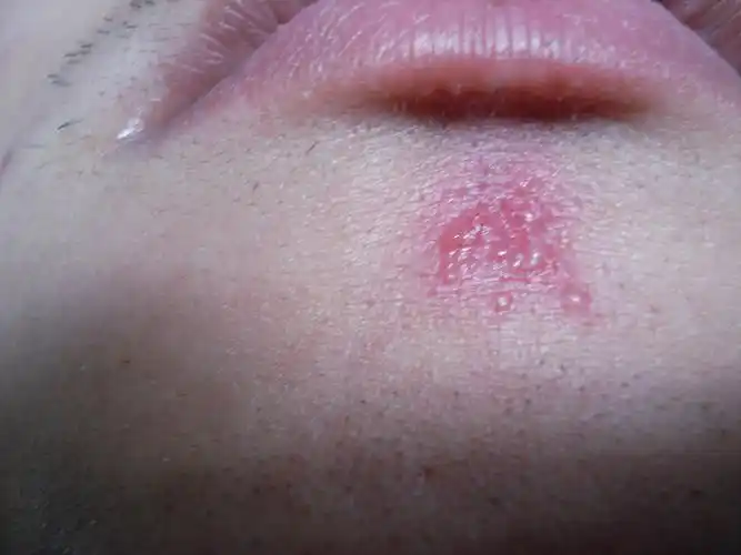 我下巴上长了像癣的红色的斑,会流一点脓,第二次长了.求解答