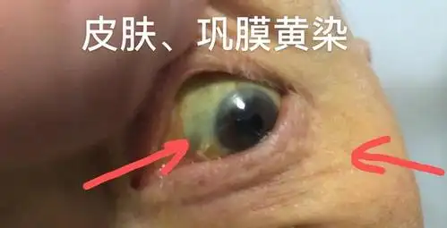 成人黄疸如何确诊治疗疫情期间烟台毓璜顶医院专家手绘草图解答