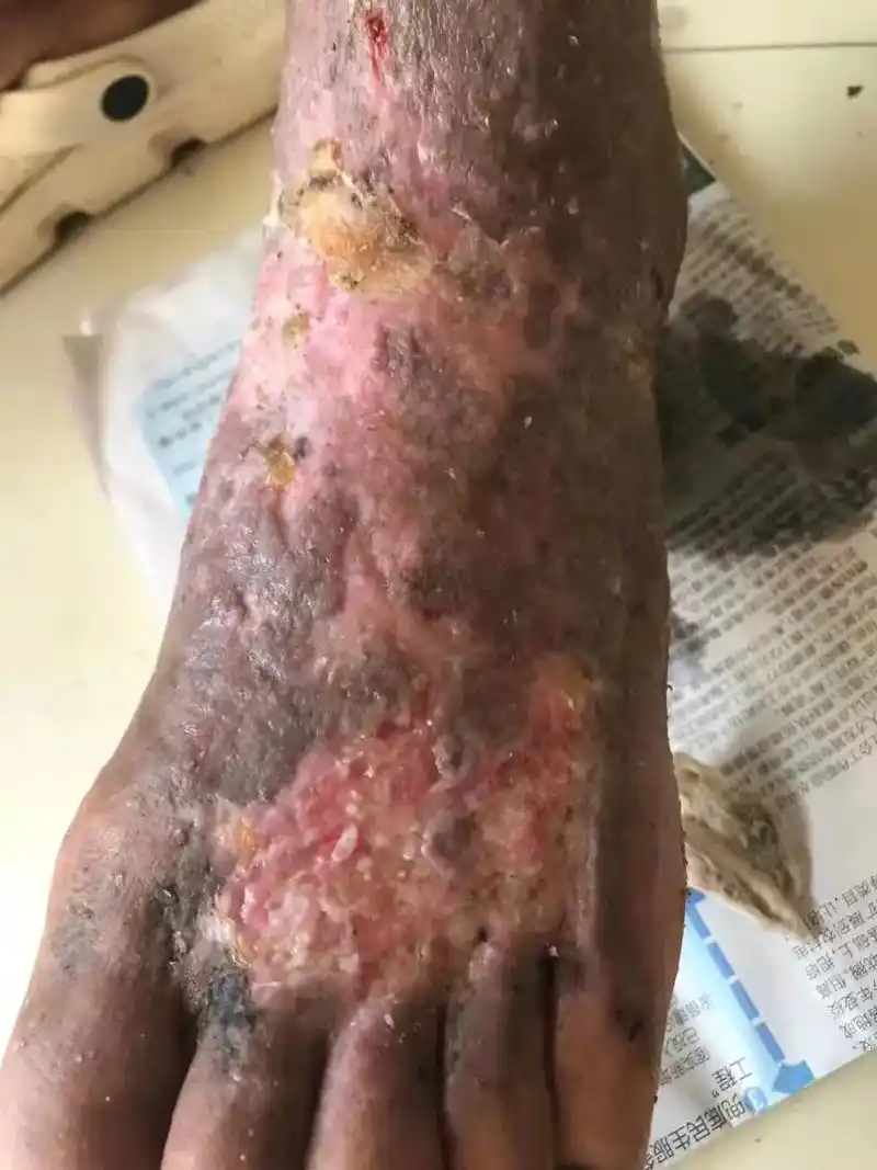 专治擦伤 .  伤口长期不愈合   见效快:  疗程短    - 抖音