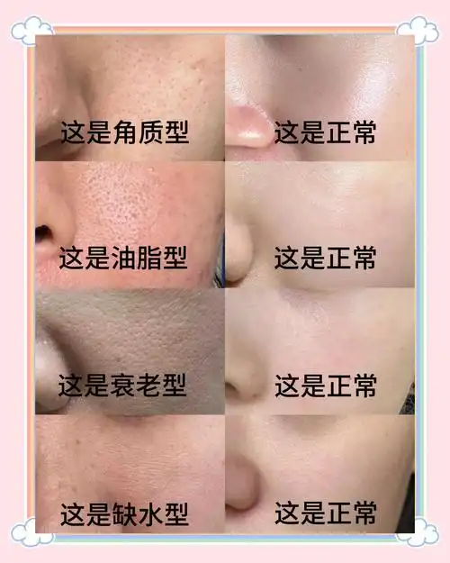 轻松应对各种毛孔类型!