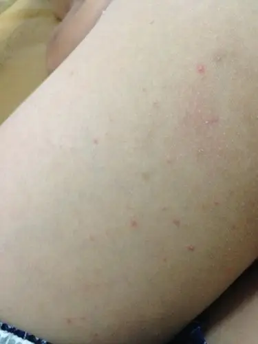 请问:初中男孩大腿后侧长了一些小红点,是天热,打球流汗以后长的,是痱