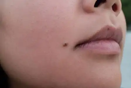 亚洲女孩脸上的痣照片