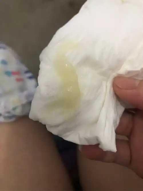 有和我一样的吗果冻状的白带