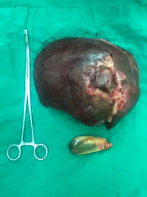 巨大肝癌行右半肝切除手术1例_肝癌_肝癌治疗方式 - 好大夫在线