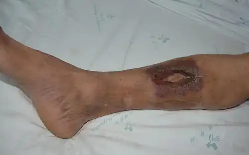 骨髓炎,临床症状有高热,肢体疼痛,最后流出黄色脓液,还伴有死骨,窦道