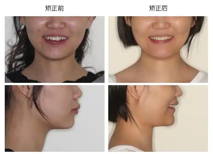 拥挤的牙齿越来越不齐?矫正迫在眉睫