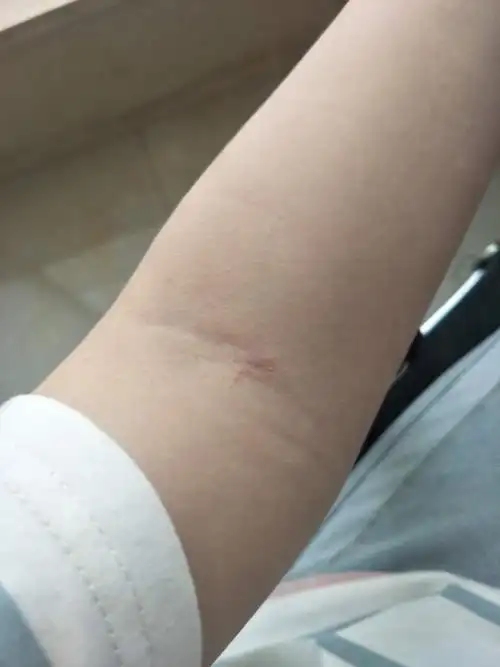 手肘内侧无缘无故长了一个跟伤疤很像的东西,不疼不痒的,是什么原因