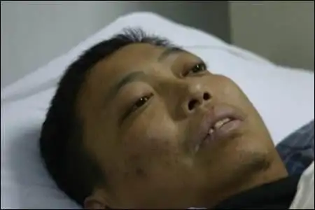 而一旦出现明显的肝硬化症状,肝硬化也差不多到了中晚期,可以说已经不