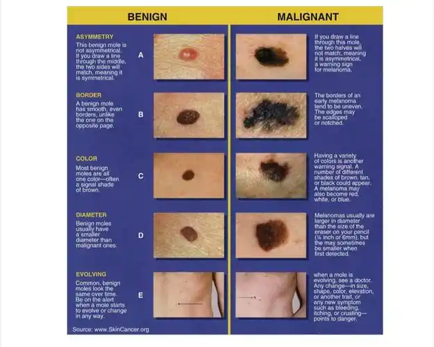 痣的良,恶性初步判断—abcde法则 - 好大夫在线