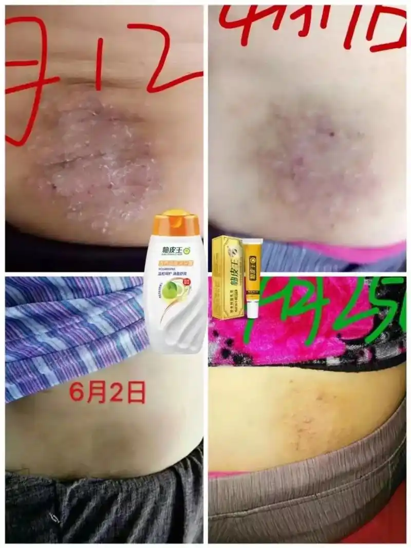 柚子皮神奇之处皮肤亚健康反馈健康洗护