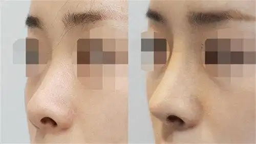 深圳广和整形美容医院鼻小柱延长美容日记公开,快来看看效果图吧!