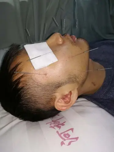 面神经炎的康复治疗