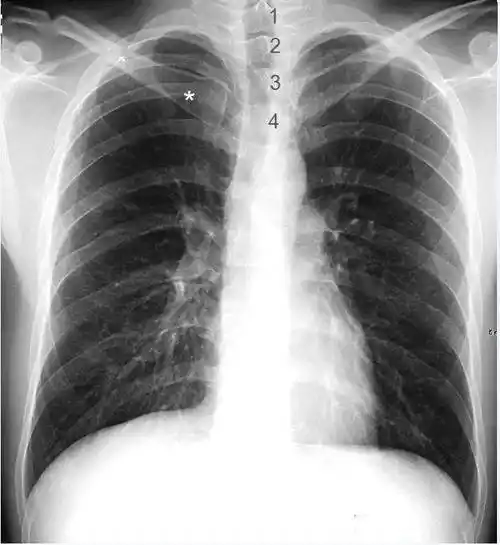 影像解剖入门 | 正常胸片怎么看?