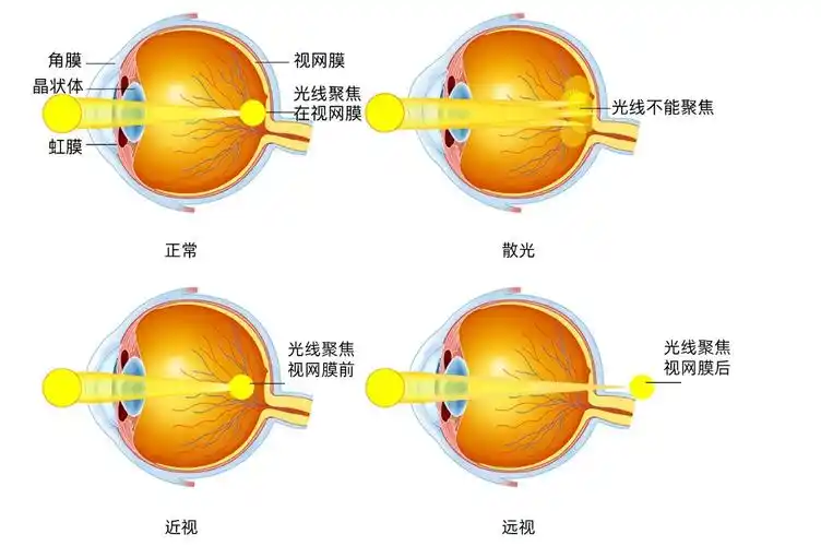 散光在什么范围内能够做近视手术?凤凰网河南_凤凰网