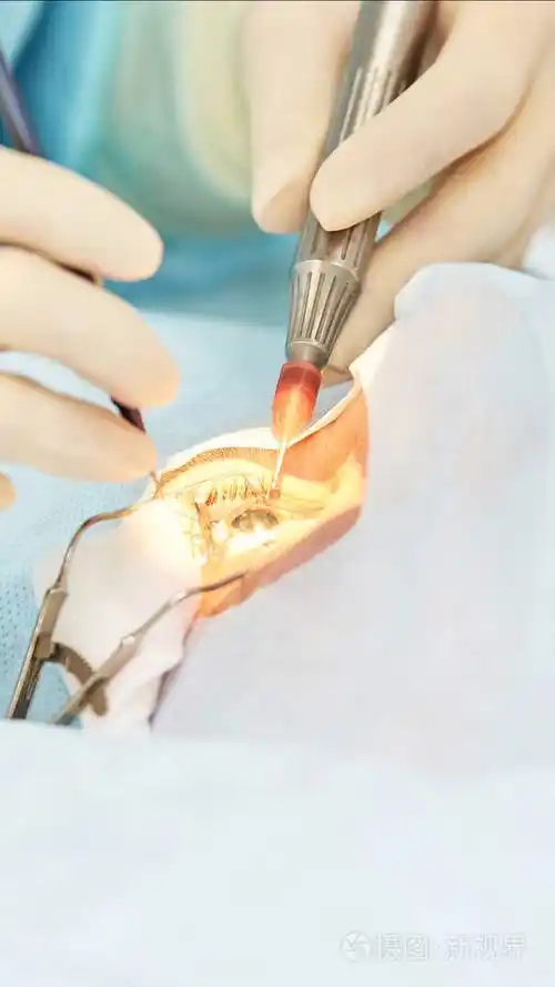 眼科激光显微镜手术门诊医生病人的眼睛治疗近视与白内障摘除术