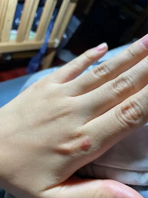 不知道被什么虫子咬的