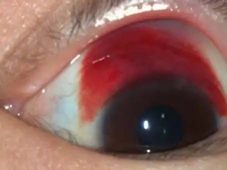 眼睛流血图片 (2)_有来医生