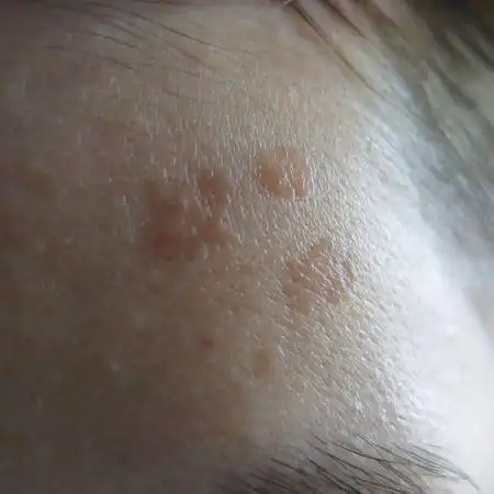 我25岁,额头长了一些很像老年斑的褐色斑块,左肩也有,哪位专家帮我