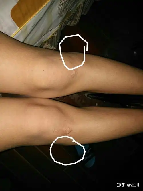 腿型很奇怪,腿很细,但是腿部膝盖部位骨头内侧很突出,请问有矫正的