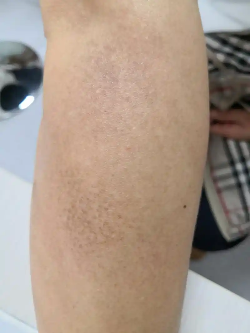 考虑色素沉着过度症状.活检排查一下诊断比较好.