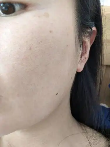 这是毛孔堵塞还是粗大还有救么