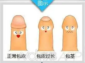 刘女士将儿子带到了东华医院去就诊,医生说,孩子有包茎,包皮过长问题