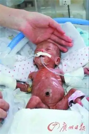 广东现最轻早产婴儿:重550克 身长30厘米(组图)
