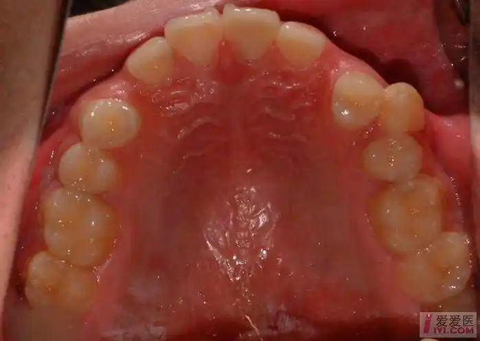 08-15 07:11:13男, 17岁  主诉:牙间隙,牙列不齐  检查:面型无异常