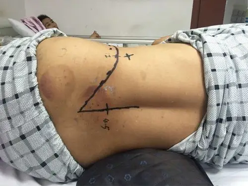 男.52岁 典型腰椎间盘突出症病例