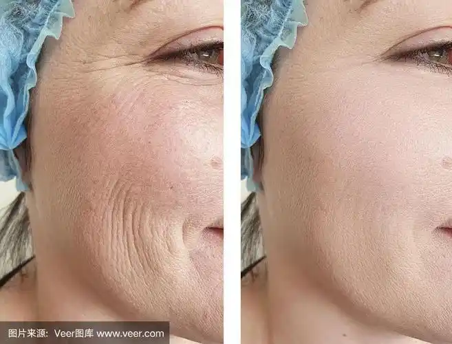 女人皱纹面部治疗前后