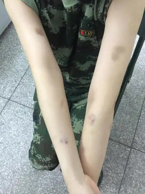 30岁张馨予为了节目太拼了!被狗拖行浑身伤痕却没有赢得网友好评