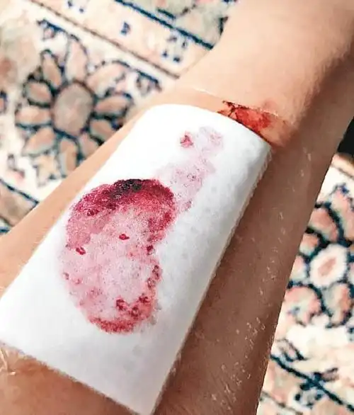 伤口隔着纱布有些血渗出来.