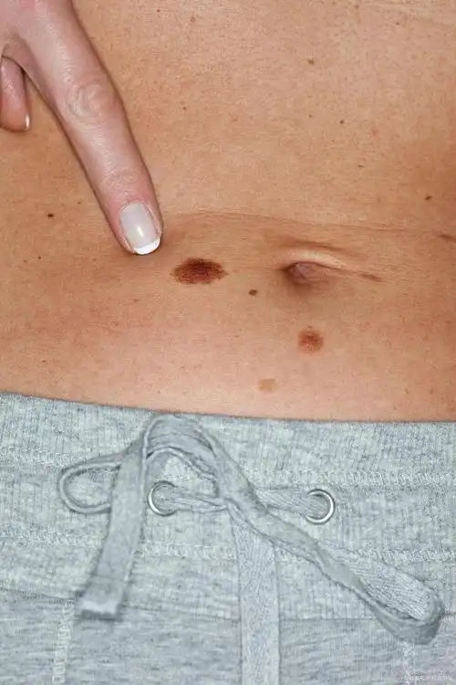 黑色素瘤到底与日晒有没有关系?