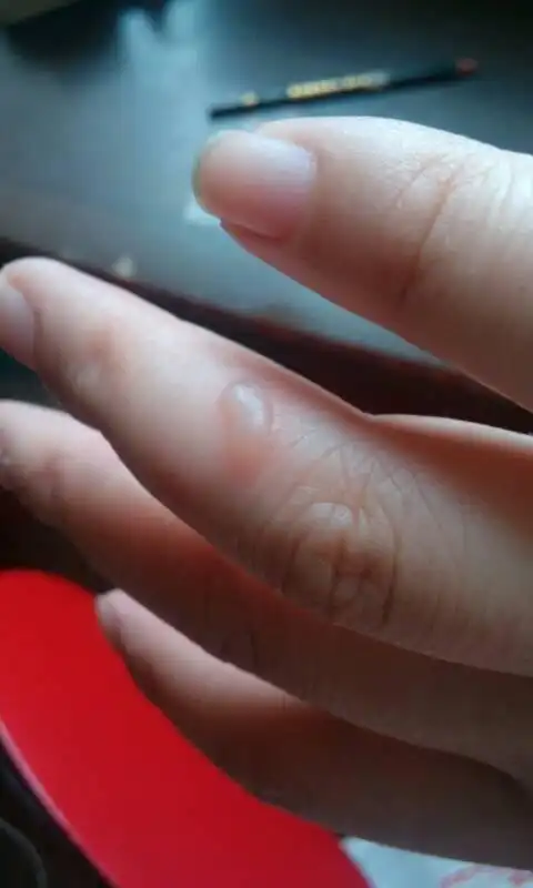 手指被轻微烫伤怎么办?手指被烫伤了非常疼怎么办?-图片大观-奇异网