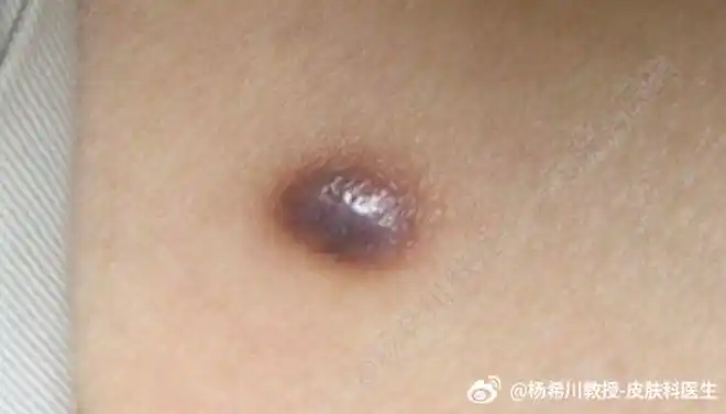 杨教授每周病例分享:【皮肤纤维瘤】