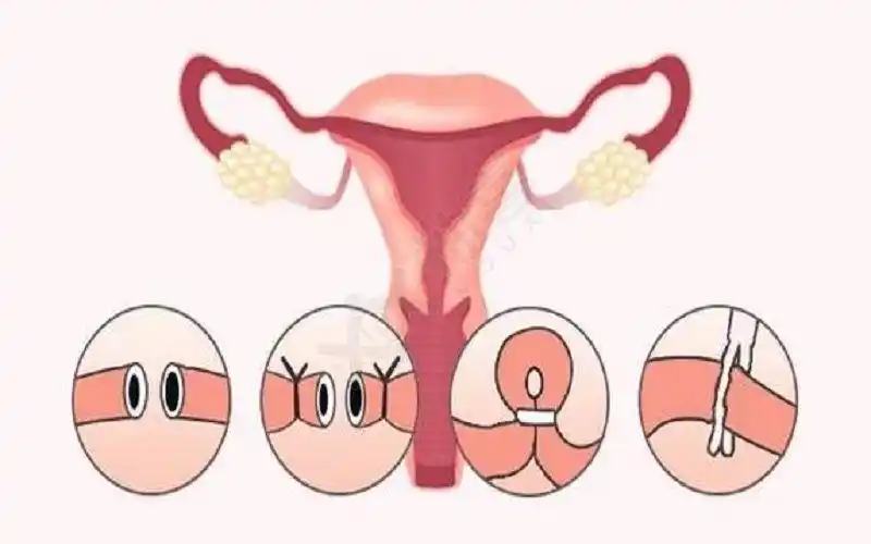 女性结扎复通过程图