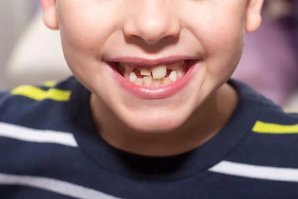 首先,我们得明确一个观点:小孩的牙齿不齐并不一定都